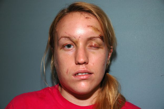 Melissa recibió cirugías en Boston para regenerar los nervios y músculos de su cara.