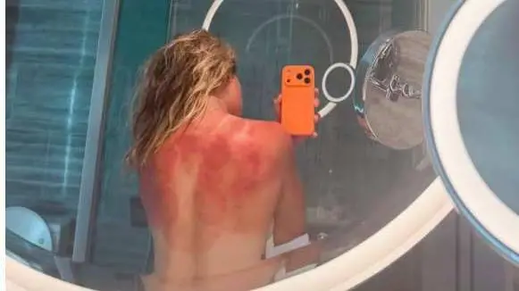 "El sol de Australia no es broma": la foto de una tenista mexicana que muestra el riesgo solar
