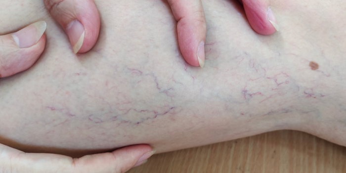 Várices y salud vascular: claves para prevenir su avance