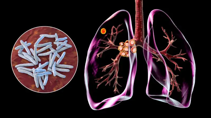 La bacteria puede vivir dentro de nosotros muchos años, y luego atacar. Algunos cuerpos la vencen, otros no.