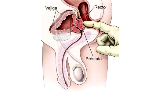 Comenzó campaña que promueve la educación y diagnóstico precoz del cáncer prostático