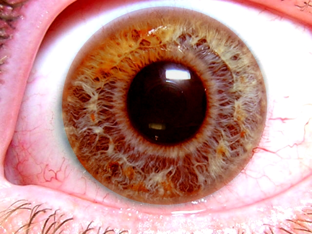El glaucoma es la primera causa  irreversible de ceguera en el mundo y la mitad de las personas que lo padecen no lo saben