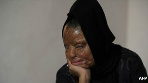 India regula la venta de ácido para reducir los ataques contra mujeres