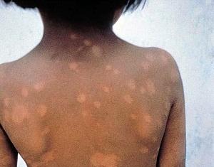 Organización Panamericana de Salud analizará casos de lepra en Buenos Aires