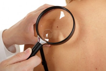 Una campaña gratuita para detectar el cáncer de piel