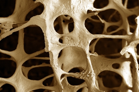 Osteoporosis: qué es y cómo enfrentar la enfermedad de los huesos