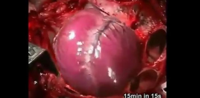 [Video] Así se ve un infarto al corazón en cámara rápida