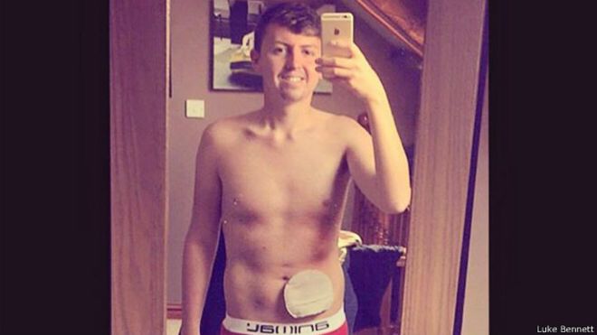 El joven que decidió mostrar su bolsa de colostomía y se volvió un fenómeno viral