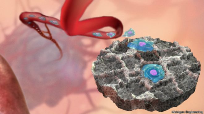 El implante-esponja que atrapa las células del cáncer dentro de tu cuerpo