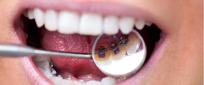 La ortodoncia invisible para lograr una sonrisa perfecta