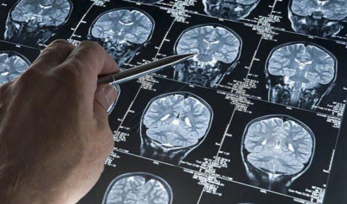 Chilena investiga nuevo tratamiento para combatir el Alzheimer