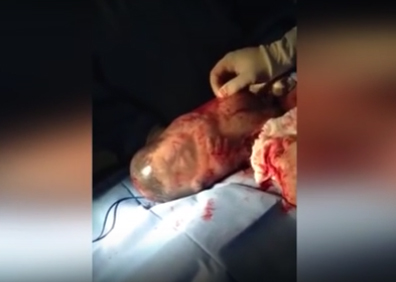 [Video] El extraordinario nacimiento de bebé dentro de su saco amniótico