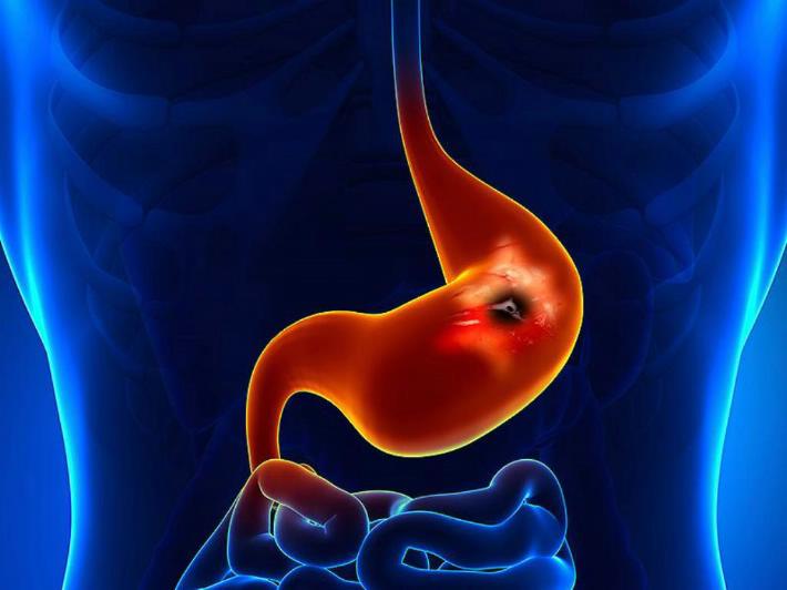 Día mundial contra el cáncer: salud digestiva en jaque