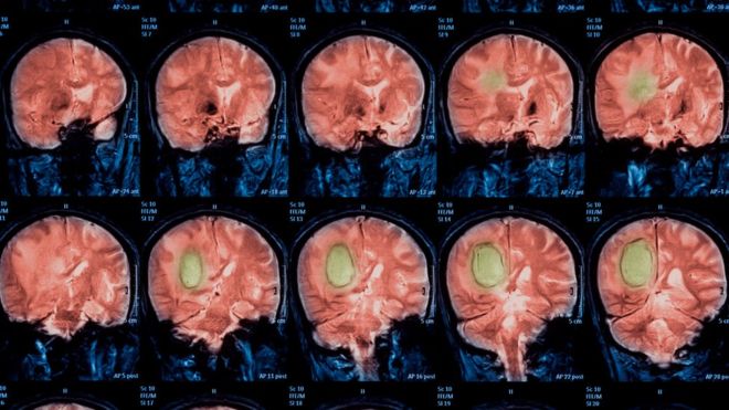 Científicos concluyen que resultados de escáneres cerebrales acumulan 15 años de errores
