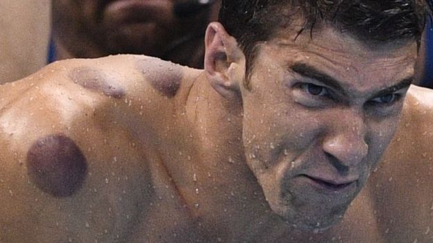 Río 2016: ¿qué son los círculos rojos en la espalda de Michael Phelps y otros atletas olímpicos?