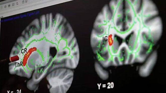 Neurocientíficos analizan con resonancia magnética cerebro de pedófilos