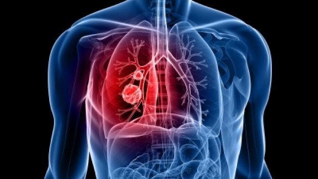 Tratamiento de inmunoterapia supera a la quimioterapia contra el cáncer de pulmón