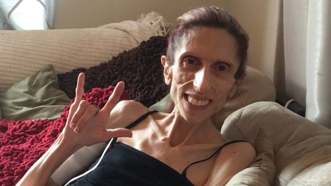 «No quiero ser la que no sobrevivió»: la nueva esperanza para Rachael, una mujer que pesa 20 kilos por causa de la anorexia
