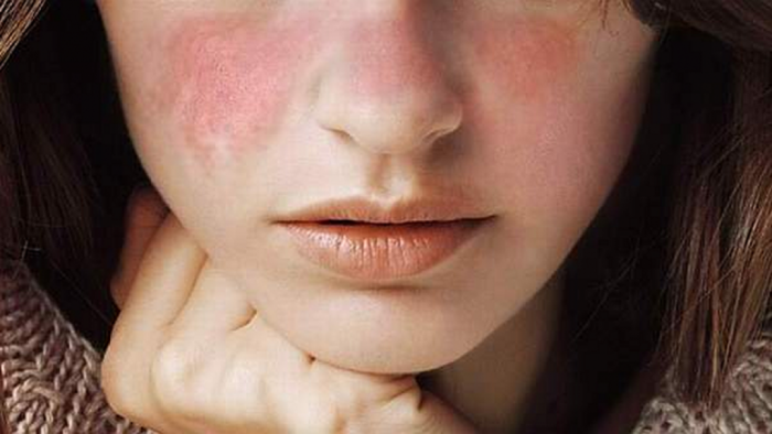 Lupus: síntomas y tratamiento de esta silenciosa enfermedad autoinmune