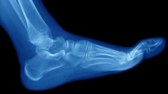 ¿Qué son las fracturas de huesos por estrés y quiénes son más propensos a sufrirlas?