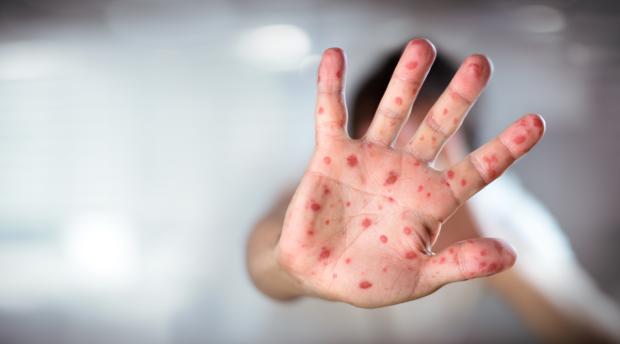 Muere un niño de sarampión tras ser contagiado por sus hermanos no vacunados
