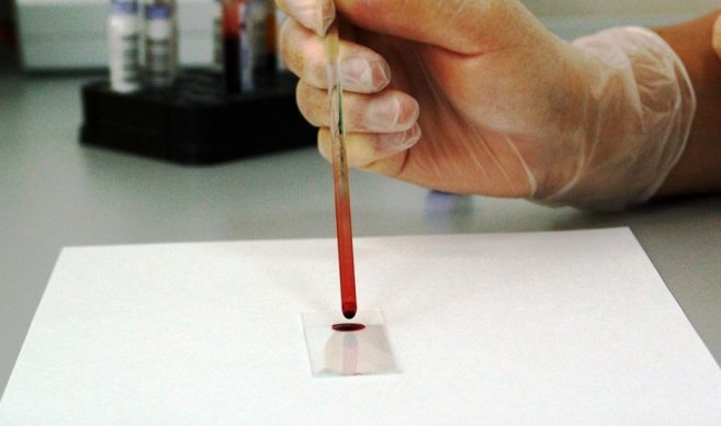 Biopsia líquida, alternativa no invasiva para detectar cáncer en la sangre