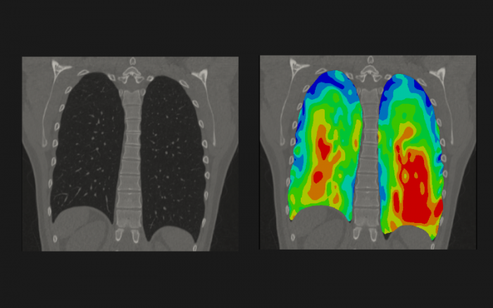Inédita investigación que une a ingenieros y matemáticos busca predecir daño pulmonar