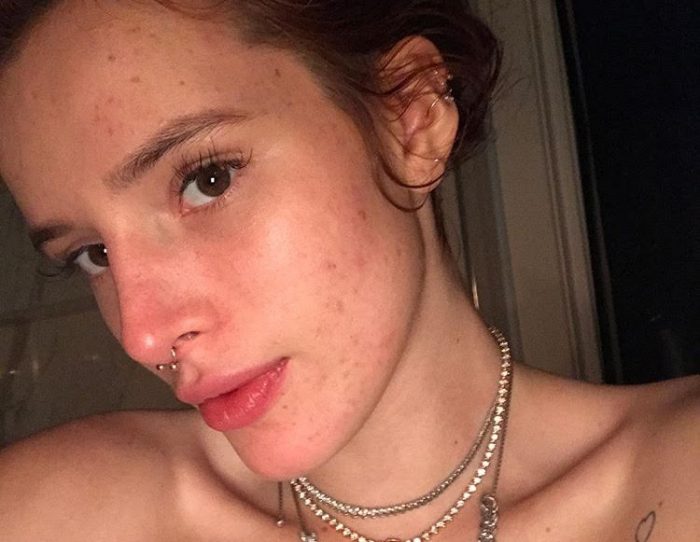 Chica Disney muestra su rostro con acné