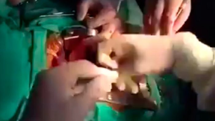 [VIDEO] La aplaudida reacción de médicos mexicanos que fueron sorprendidos por el terremoto 7.1 durante operación a corazón abierto