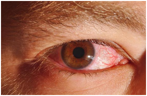 Riesgos y enfermedades a la vista provocadas por exposición prolongada y sin protección a luz solar