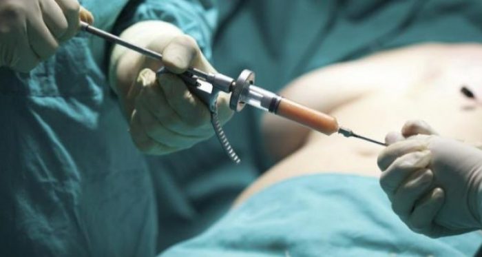 Mujer fallece durante liposucción: ¿Qué cuidados hay que tomar antes de someterte a una cirugía estética?