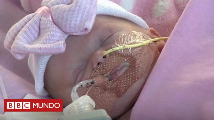 [VIDEO] La conmovedora fortaleza de una bebé que nació con el corazón fuera del pecho