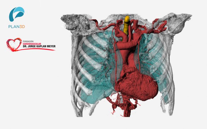Cardiología Y Biomodelos 3D: Se unen para innovar en beneficio de los pacientes