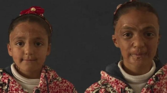 [VIDEO] «Quiero ser tan bonita como era antes»: la conmovedora historia de dos niñas sirias que quedaron desfiguradas por un bombardeo
