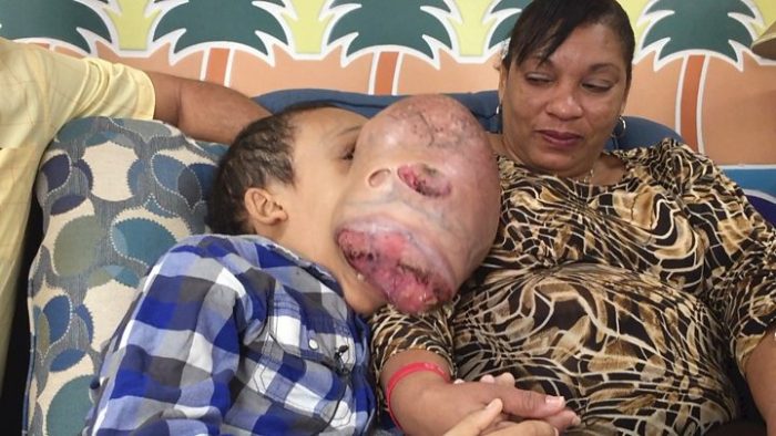 [VIDEO] «Emanuel siempre ha dicho ´yo sí puedo seguir adelante´»: el niño cubano con un tumor en la cara que será operado en Estados Unidos