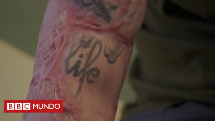 [VIDEO] «Mi hermano es un héroe»: cómo un hombre salvó la vida de su gemelo donándole la mitad de su piel