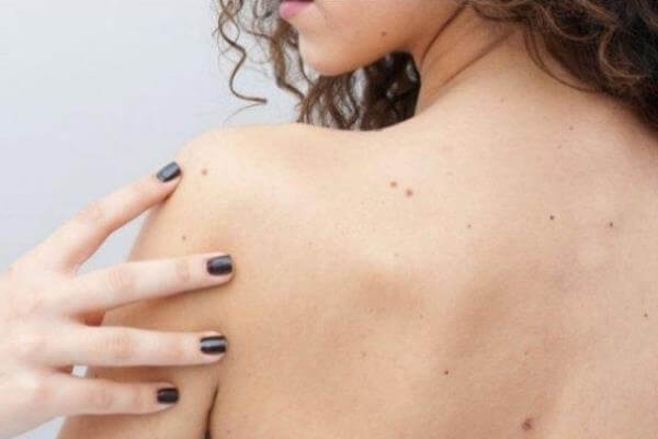 Revisa tus lunares y previene el cáncer de piel