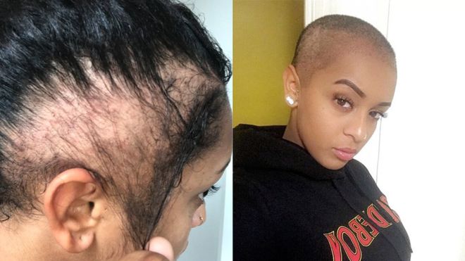 «Mi peinado terminó dejándome calva»: Paigey Cakey, la joven rapera británica con «alopecia de tracción»