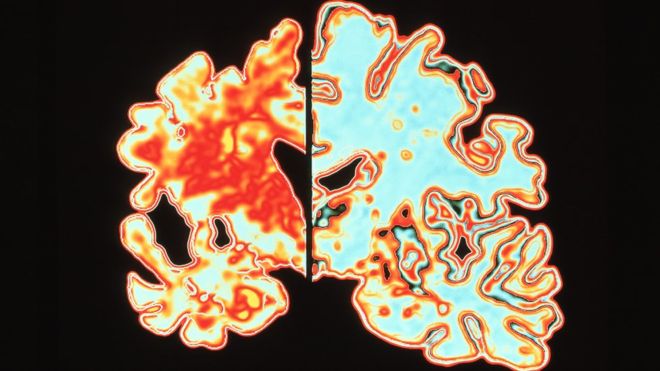 Qué es la «cascada amiloide», la hipótesis que domina la investigación sobre el Alzhéimer desde hace 25 años