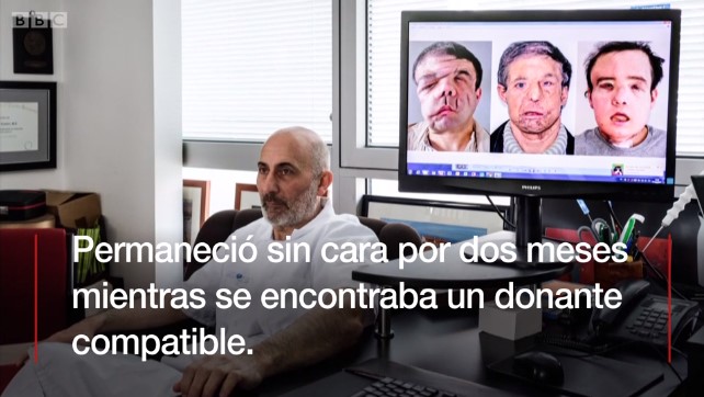 [VIDEO] El primer paciente que recibe dos trasplantes de cara en el mundo