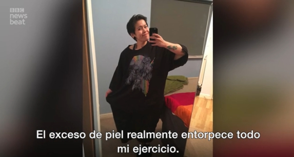 «Me adelgacé 120 kilos pero odio la piel que me sobra»