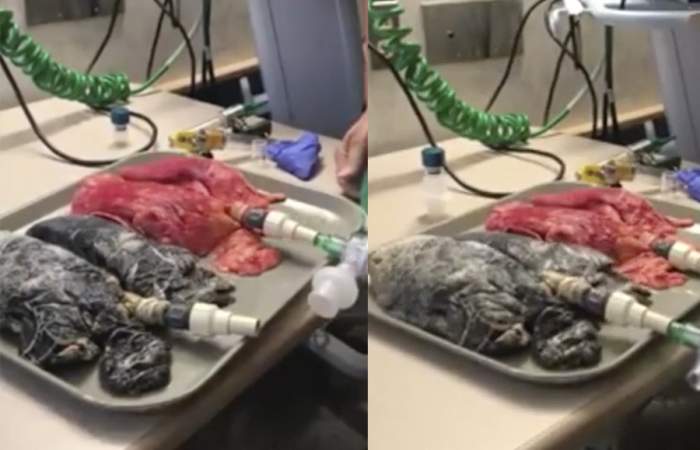 ¿Ganas de fumar? Enfermera publica impactante diferencia entre pulmones de fumador y unos sanos
