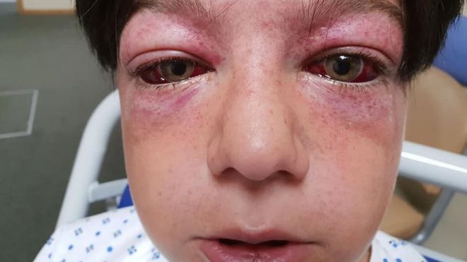 El peligroso reto de YouTube que le causó heridas «vistas en los pilotos de combate» a un niño de 11 años