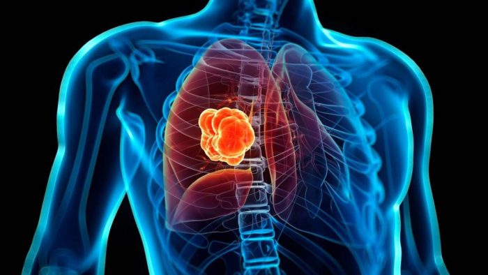 Estigma del cáncer de pulmón frena acceso a tratamientos en América Latina