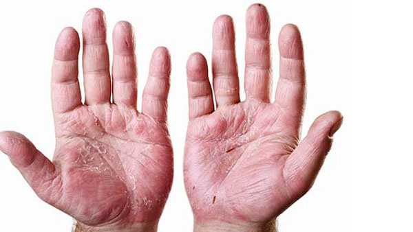 Artritis Psoriásica: una enfermedad que si no se controla puede llegar a ser invalidante