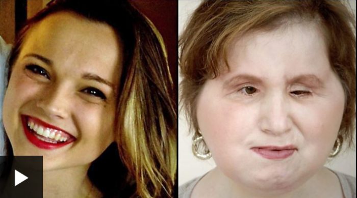 Katie Stubblefield, la joven que recibió un trasplante de cara después de intentar suicidarse