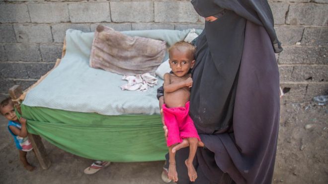 Guerra en Yemen: 85.000 niños han muerto por desnutrición
