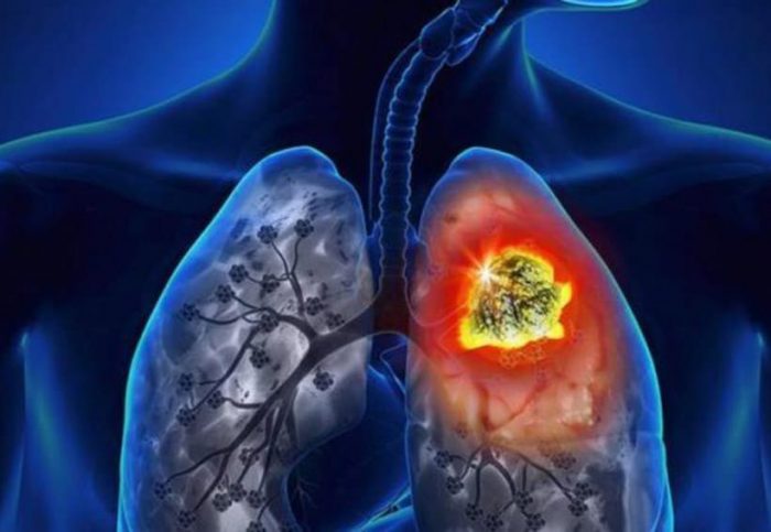 Cáncer de pulmón: cómo identificar esta patología GES