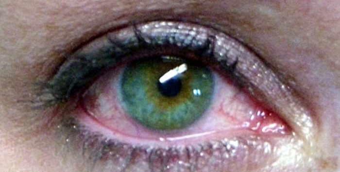 Ojo seco: el síndrome que puede dificultar la salud visual en verano