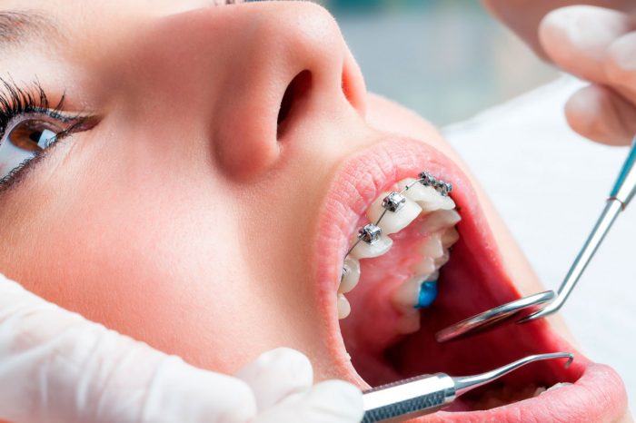 Frenillos después de los 30: adultos optan cada vez más por tratamientos de ortodoncia